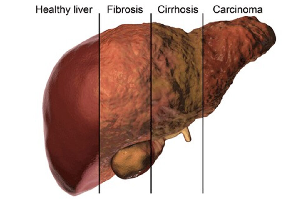 Fatty Liver Tips