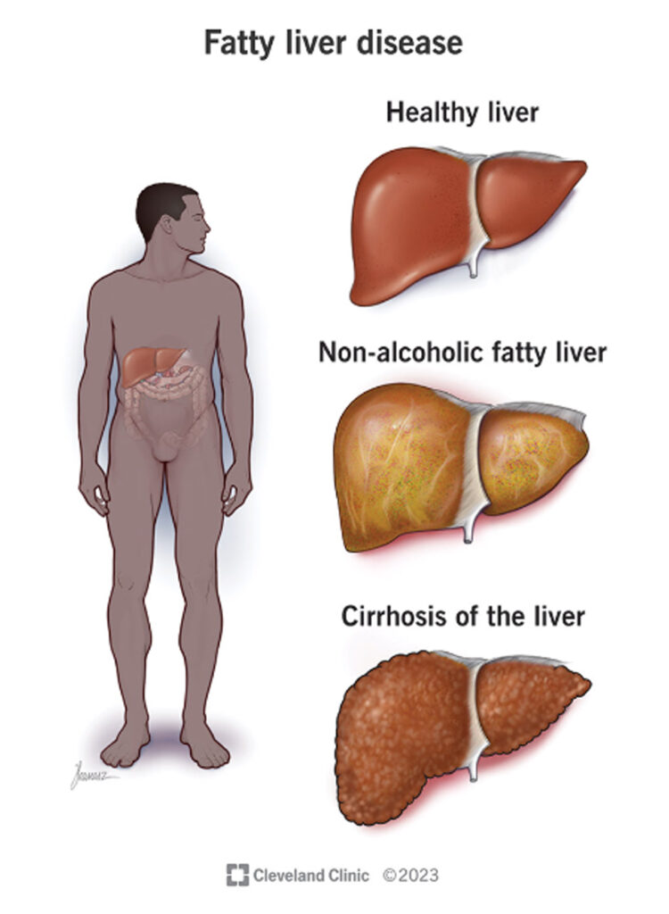 Fatty Liver Tips