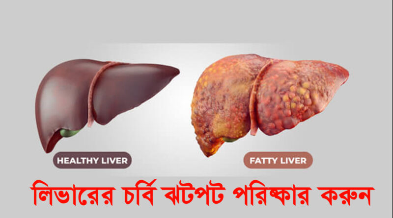 Fatty Liver Tips