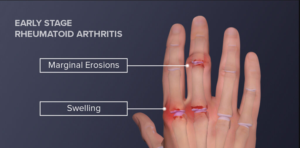 Health Tips Arthritis