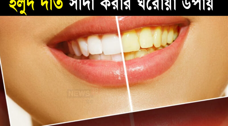 Home Remedies For Yellow Teeth