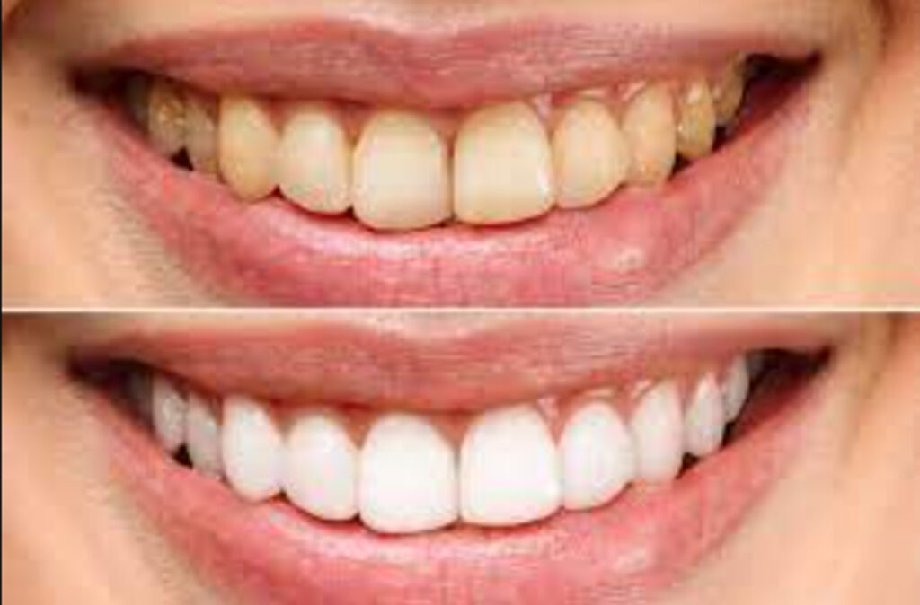 Home Remedies For Yellow Teeth