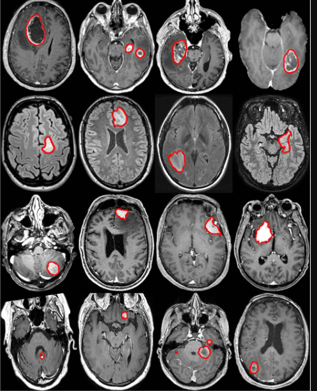 brain tumor cause treatment