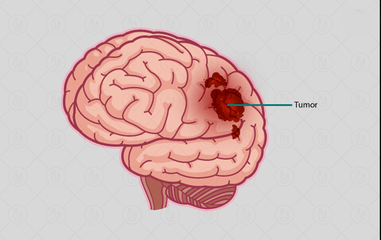 brain tumor cause treatment