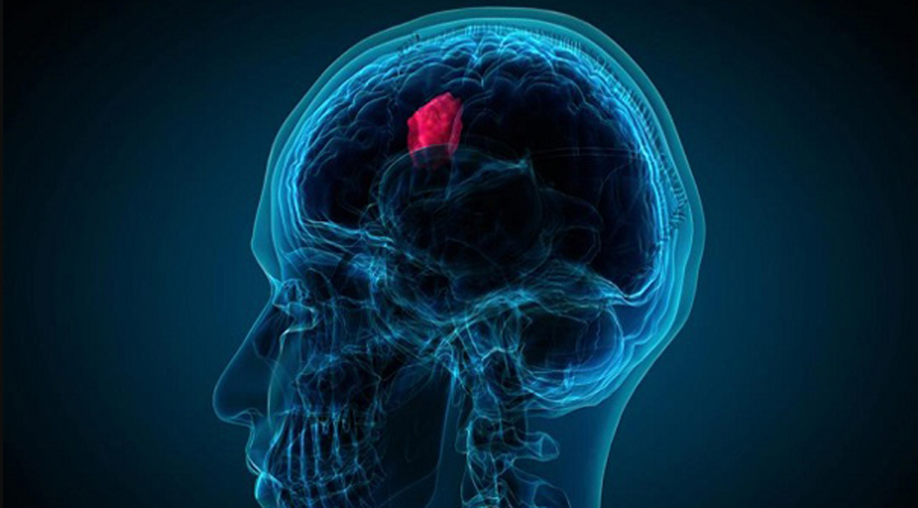 brain tumor cause treatment