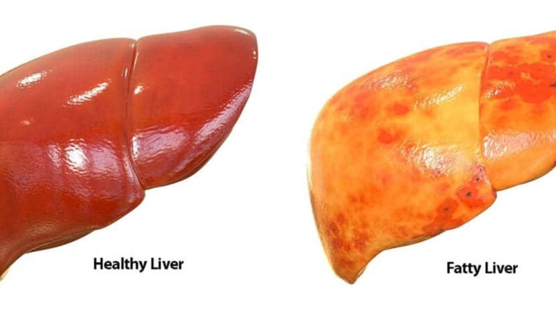 Fatty liver: ফ্যাটি লিভার, এই এক পানীয়ে ফ্যাটি লিভার অ্যারেস্ট, জেনে নিন কখন খাবেন